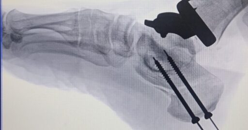 Reemplazo articular del tobillo y osteotomía correctiva del calcáneo