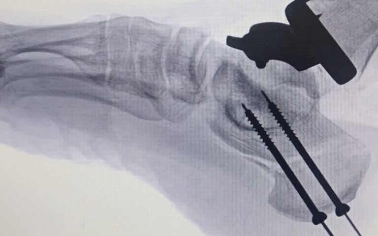 Reemplazo articular del tobillo y osteotomía correctiva del calcáneo