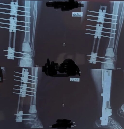 Rescate de Osteomielitis Crónica