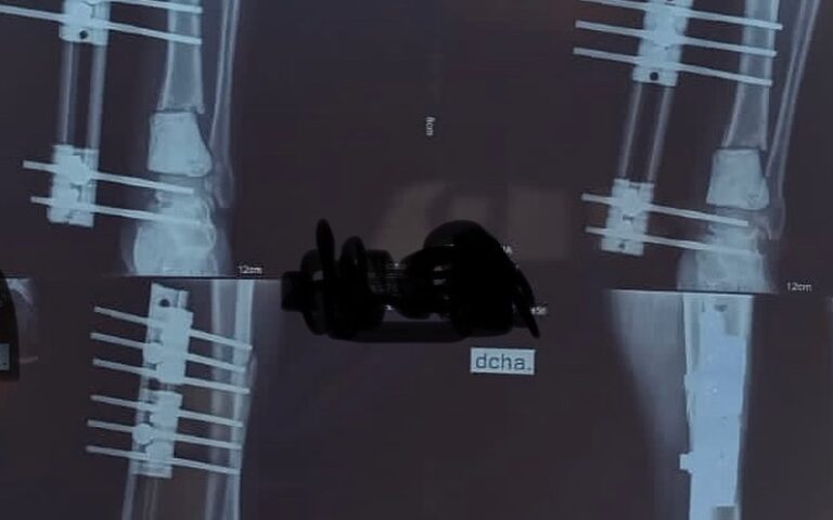 Rescate de Osteomielitis Crónica