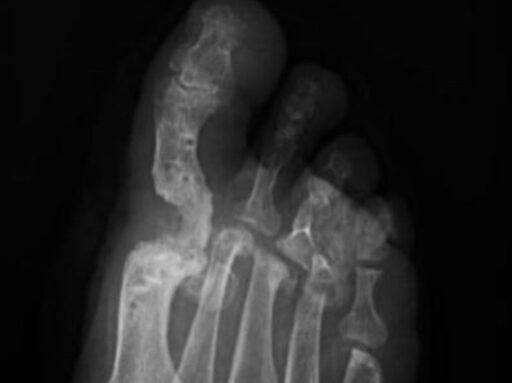 Rescate de pseudartrosis artrodesis de hallux