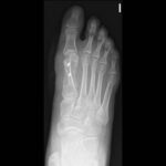 Opciones de tratamiento para Hallux valgus – Juanete