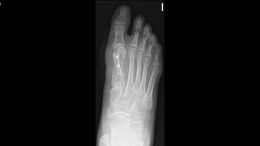 Opciones de tratamiento para Hallux valgus – Juanete
