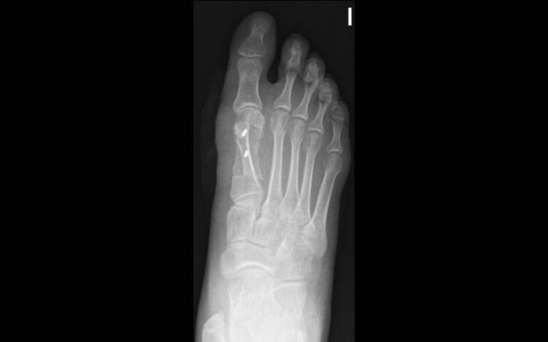 Opciones de tratamiento para Hallux valgus – Juanete