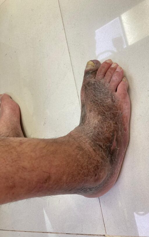 Artropatia diabetica