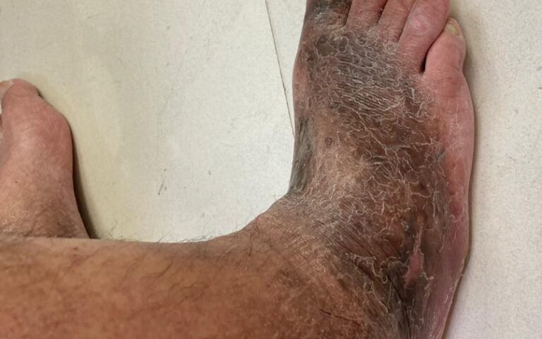 Artropatia diabetica