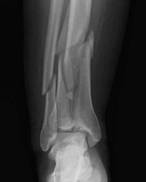 Manejo inicial en las fracturas complejas de tibia