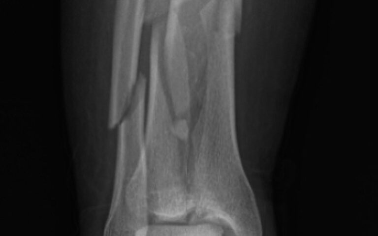 Manejo inicial en las fracturas complejas de tibia