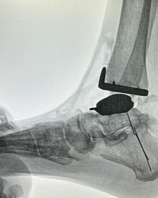 Reemplazo articular del tobillo