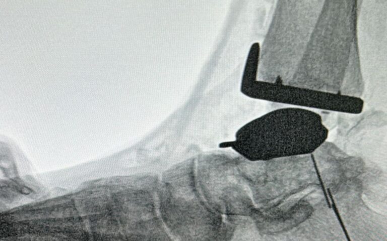 Reemplazo articular del tobillo